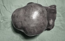 Phẫu thuật cắt khối u gan nặng gần 2kg cho bệnh nhân 73 tuổi
