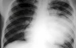 Viêm phổi thùy ở trẻ em: Gia tăng ca bệnh, biến chứng khó lường
