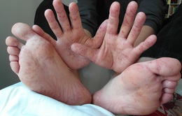 An Giang: Bệnh tay chân miệng diễn biến phức tạp