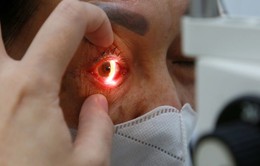 Sở Y tế TP. Hồ Chí Minh phối hợp với Đại học Oxford xác định tác nhân gây đau mắt đỏ