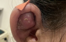 Cẩn trọng biến chứng nguy hiểm khi xỏ khuyên trên vành tai