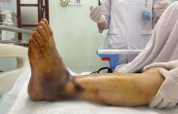 Nối bàn chân đứt lìa cho người bệnh bị tai nạn lao động