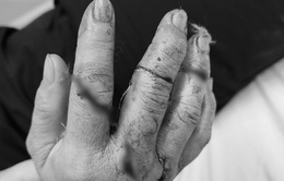 Nối ngón tay đứt gần lìa cho người bệnh bị tai nạn lao động