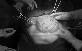 Bóc tách khối u xơ tử cung to bằng "quả bóng" cho bệnh nhân