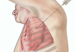 Sinh thiết phổi xuyên thành ngực có rủi ro hay không?