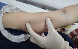 Đắk Lắk ghi nhận trường hợp thứ 4 tử vong do sốt xuất huyết