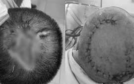 Phẫu thuật cho bệnh nhân bị tổn thương da đầu hiếm gặp