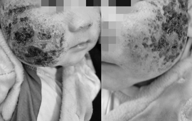 Gia đình tự đắp lá cây chữa viêm da, bé 4 tháng bị loét má