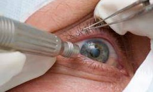 Sau phẫu thuật đục thủy tinh thể, mắt cần chăm sóc thế nào?