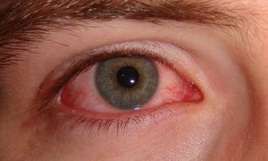 Cần làm gì để tránh lây nhiễm bệnh đau mắt đỏ?