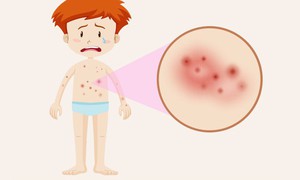 Điểm mặt các bệnh da liễu thường gặp vào mùa hè