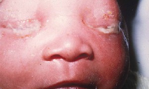Viêm kết mạc ở trẻ sơ sinh do vi khuẩn chlamydia trachomatis