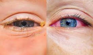 Đôi mắt bị ảnh hưởng thế nào khi dị ứng