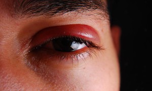 Những biểu hiện ở mắt khi mắc bệnh zona