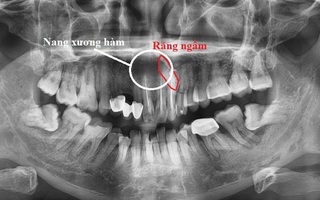 U xương hàm: Sưng đau môi trên lâu ngày: Cẩn trọng có thể bạn mắc ...