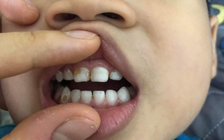 TP. Hồ Chí Minh: Thí điểm triển khai mô hình trường-trạm trong chăm sóc sức khoẻ răng miệng học sinh