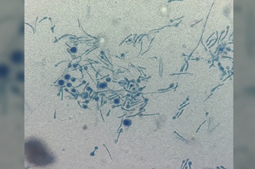 Phát hiện trường hợp đầu tiên nấm thực vật Chondrostereum purpureum lây nhiễm cho người