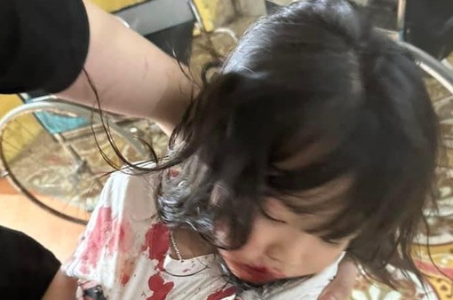 Đang chơi trên vỉa hè, bé gái 5 tuổi bị chó lạ tấn công