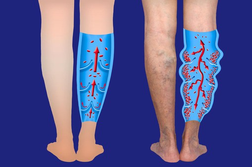 Tái phát sau điều trị suy giãn tĩnh mạch chân bằng laser xung dài