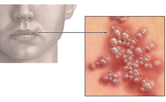 Phòng ngừa và điều trị bệnh mụn rộp quanh miệng do siêu vi