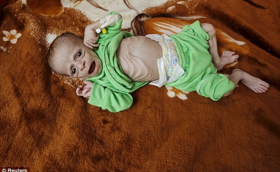 Trẻ em - Nạn nhân vô tội của nạn đói trong nội chiến Yemen