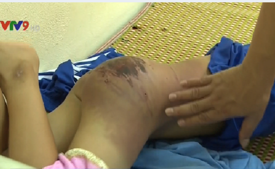 Cháu bé 13 tuổi bị cha đánh tại Thái Nguyên có thể xuất viện sau 1 tuần