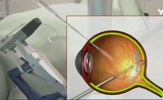 Robot phẫu thuật bên trong mắt đầu tiên trên thế giới