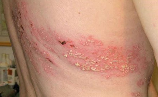 Phân biệt viêm da tiếp xúc do kiến ba khoang và bệnh zona