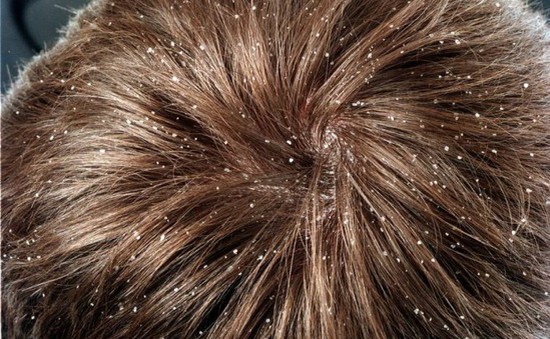 Rụng tóc, gàu và nấm da đầu - Bệnh gì?