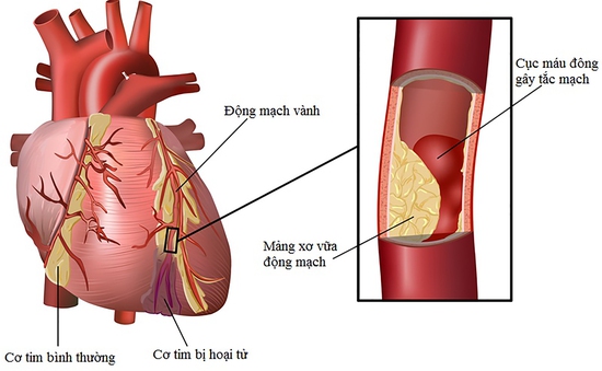 Rối loạn mỡ máu là nguyên nhân gây bệnh tim mạch