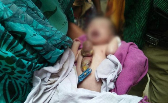 Ấn Độ: Bé gái sơ sinh có tim ngoài lồng ngực