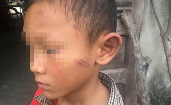 Điều tra nguyên nhân cháu bé bị bạo hành ở Quảng Ngãi