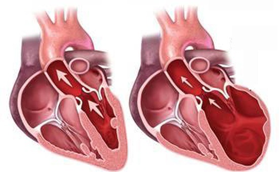 Bệnh lý cơ giãn tim có tỷ lệ tử vong cao