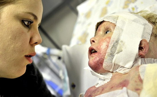 Đức: Ghép da cứu em bé mắc bệnh ly thượng bì bóng nước