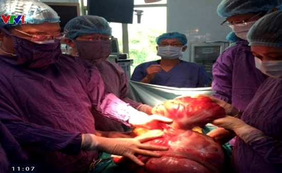 Cắt bỏ khối u khổng lồ nặng 9,5kg trong ổ bụng nam bệnh nhân