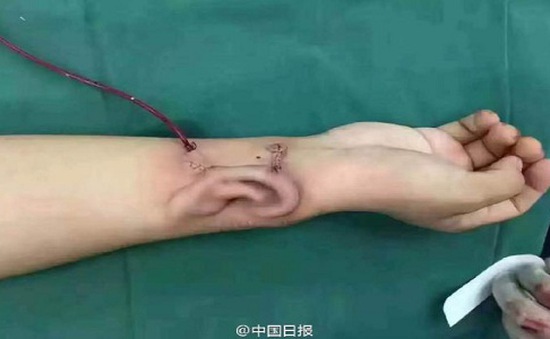 Trung Quốc: Cấy ghép thành công tai nhân tạo phát triển trên cánh tay