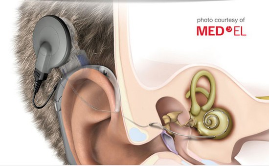 Vì sao người khiếm thính từ chối cấy ghép ốc tai?