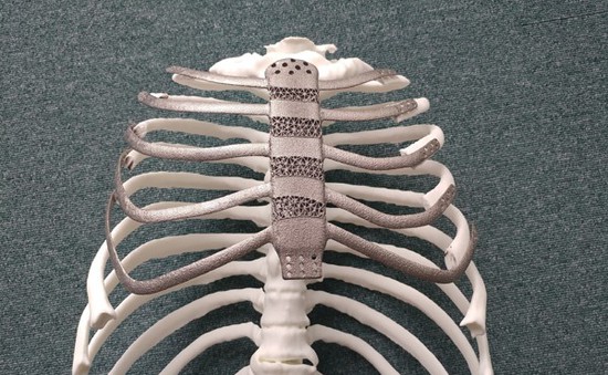 Ca ghép xương ngực nhân tạo bằng công nghệ in 3D đầu tiên tại Hàn Quốc