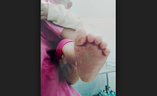 Gia đình bé gái 2 tuổi bị bỏng chân ở trường mầm non kêu cứu