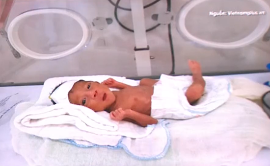 Bệnh viện đa khoa huyện Bắc Hà cứu sống trẻ sinh non nặng 900g