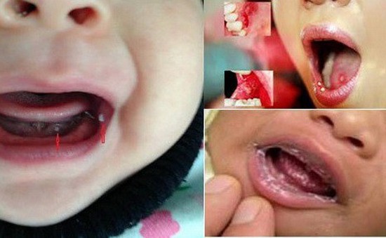 Nhận biết và điều trị nấm miệng