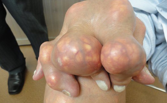 "Cục tophi” - Người mắc bệnh gout cần cẩn trọng với nguy cơ hoại tử