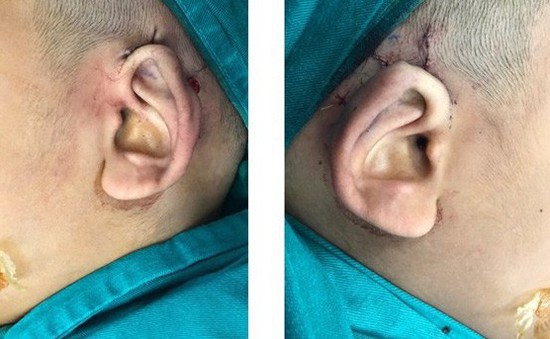 Trẻ sinh ra có vành tai bị vùi lấp được phẫu thuật tạo hình thành công