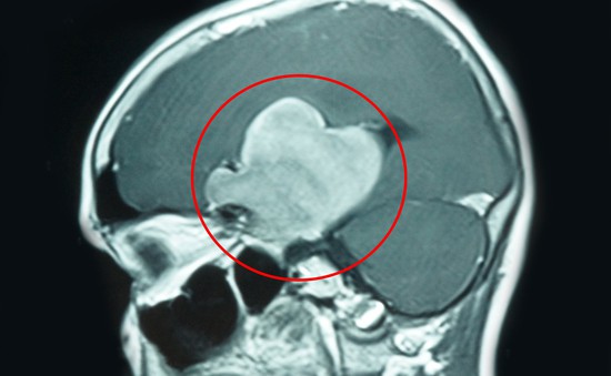Hơn 5 giờ mổ khối u não khổng lồ cho nữ bệnh nhân