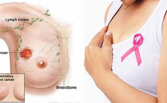 Dấu hiệu cảnh báo ung thư vú, mọi chị em nên biết