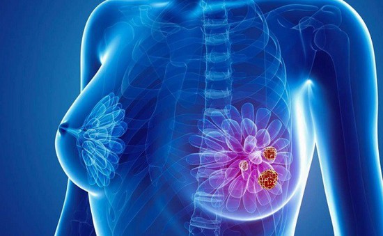Dấu hiệu cảnh báo ung thư vú ở nam và nữ