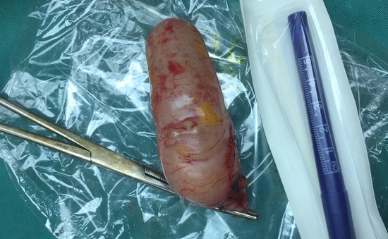 Phẫu thuật cắt u nang nhầy ruột thừa hiếm gặp