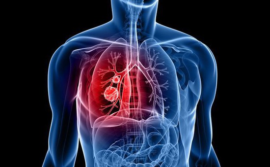 Hai phương pháp mới chữa trị ung thư phổi hiệu quả