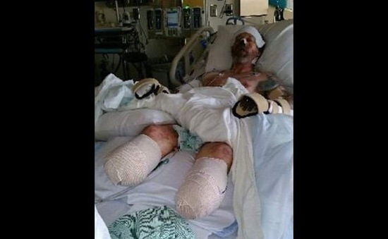 Người đàn ông bị cắt cụt tay chân do nhiễm trùng từ chó