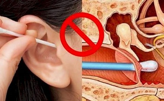 Hiểm họa từ việc lấy ráy tai không đúng cách